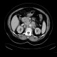 Retroperitoneal lymphadenopathy: CT - Computed tomography